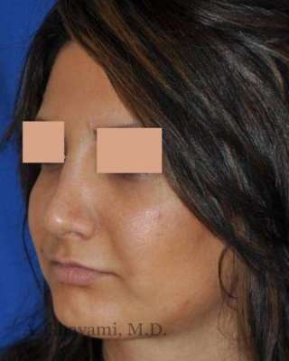 Rhinoplasty Before & After Patient #7232