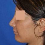 Rhinoplasty Before & After Patient #7232