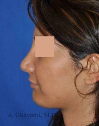 Rhinoplasty Before & After Patient #7232