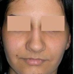 Rhinoplasty Before & After Patient #7232