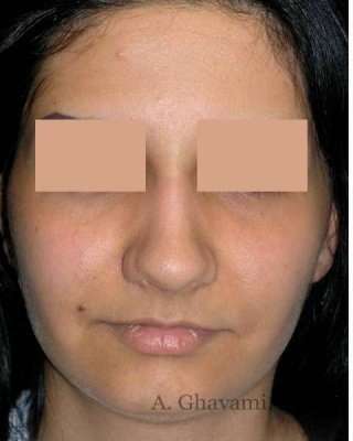 Rhinoplasty Before & After Patient #7232