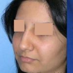 Rhinoplasty Before & After Patient #7232