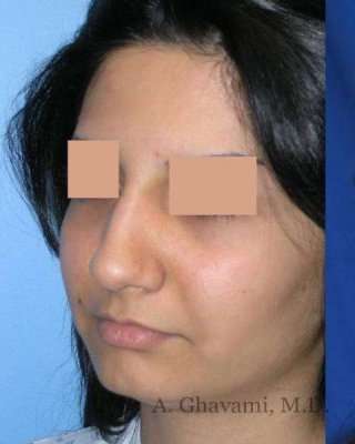 Rhinoplasty Before & After Patient #7232