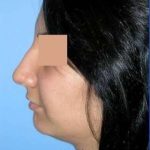 Rhinoplasty Before & After Patient #7232