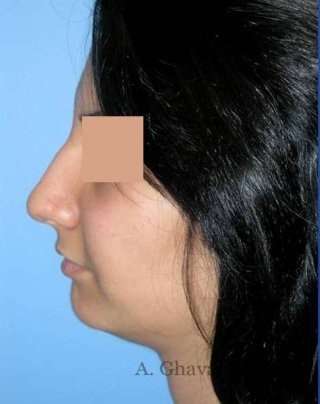 Rhinoplasty Before & After Patient #7232