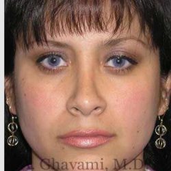 Rhinoplasty Before & After Patient #7225