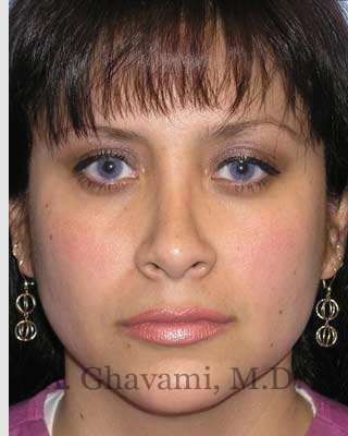 Rhinoplasty Before & After Patient #7225