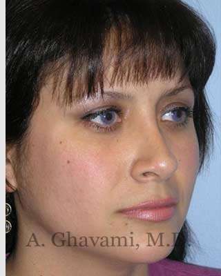 Rhinoplasty Before & After Patient #7225