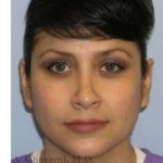 Rhinoplasty Before & After Patient #7225