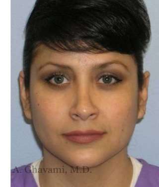 Rhinoplasty Before & After Patient #7225