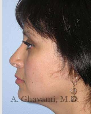 Rhinoplasty Before & After Patient #7225