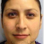 Rhinoplasty Before & After Patient #7225
