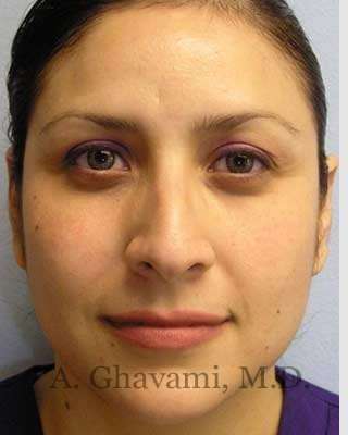 Rhinoplasty Before & After Patient #7225