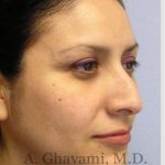 Rhinoplasty Before & After Patient #7225