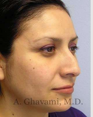 Rhinoplasty Before & After Patient #7225