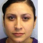 Rhinoplasty Before & After Patient #7225