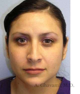 Rhinoplasty Before & After Patient #7225