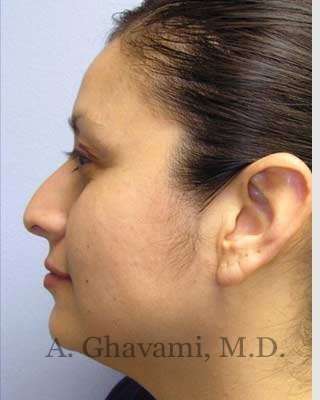 Rhinoplasty Before & After Patient #7225