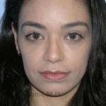 Rhinoplasty Before & After Patient #7216