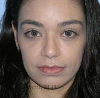 Rhinoplasty Before & After Patient #7216