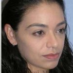 Rhinoplasty Before & After Patient #7216