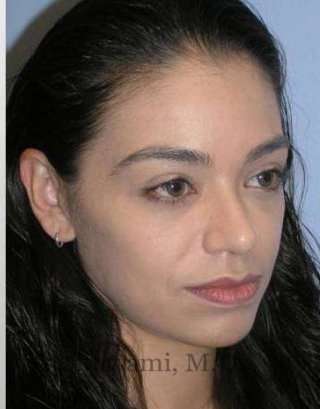 Rhinoplasty Before & After Patient #7216