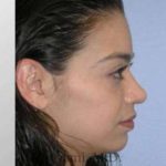 Rhinoplasty Before & After Patient #7216