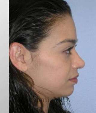 Rhinoplasty Before & After Patient #7216