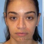 Rhinoplasty Before & After Patient #7216