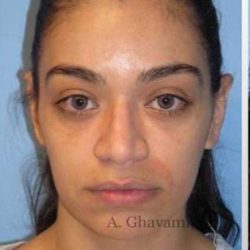 Rhinoplasty Before & After Patient #7216