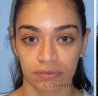 Rhinoplasty Before & After Patient #7216