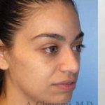 Rhinoplasty Before & After Patient #7216
