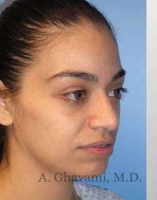 Rhinoplasty Before & After Patient #7216