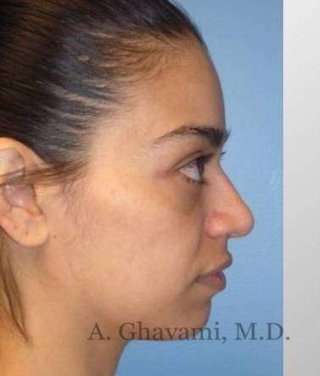 Rhinoplasty Before & After Patient #7216