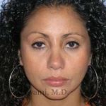 Ethnic Rhinoplasty Before & After Patient #7209