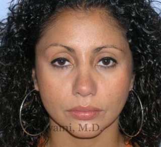 Ethnic Rhinoplasty Before & After Patient #7209
