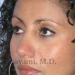Ethnic Rhinoplasty Before & After Patient #7209