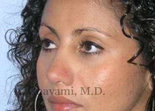Ethnic Rhinoplasty Before & After Patient #7209
