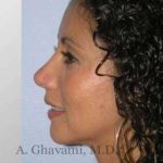 Ethnic Rhinoplasty Before & After Patient #7209