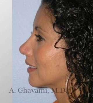 Ethnic Rhinoplasty Before & After Patient #7209