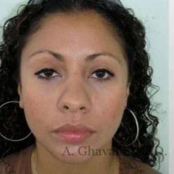 Ethnic Rhinoplasty Before & After Patient #7209