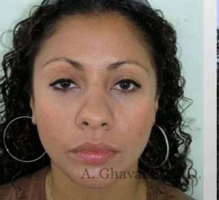 Ethnic Rhinoplasty Before & After Patient #7209
