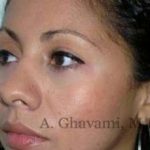 Ethnic Rhinoplasty Before & After Patient #7209
