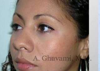 Ethnic Rhinoplasty Before & After Patient #7209