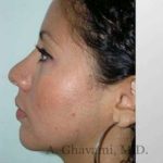 Ethnic Rhinoplasty Before & After Patient #7209