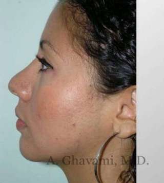 Ethnic Rhinoplasty Before & After Patient #7209