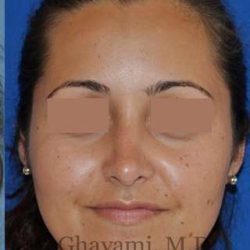 Rhinoplasty Before & After Patient #7202