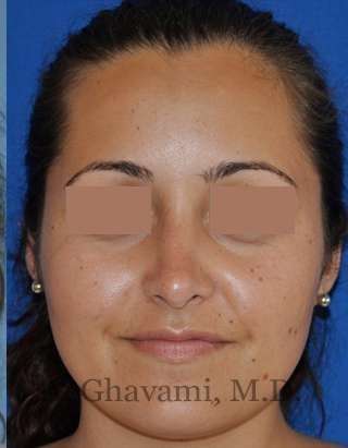 Rhinoplasty Before & After Patient #7202