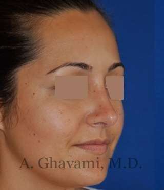 Rhinoplasty Before & After Patient #7202