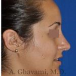 Rhinoplasty Before & After Patient #7202